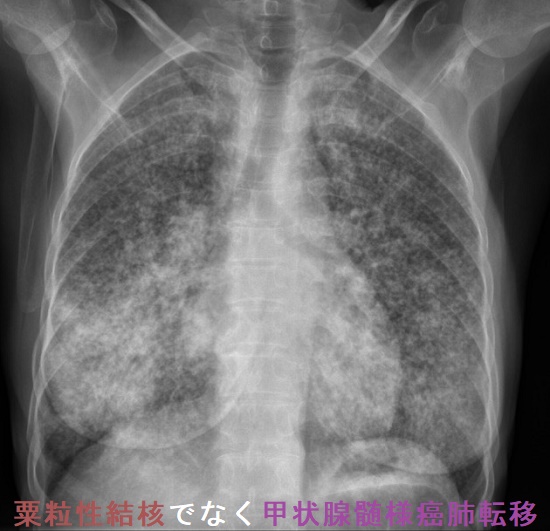 粟粒性結核でなく甲状腺髄様癌肺転移 胸部レントゲン 粟粒性結核でなく甲状腺髄様癌肺転移 胸部レントゲン