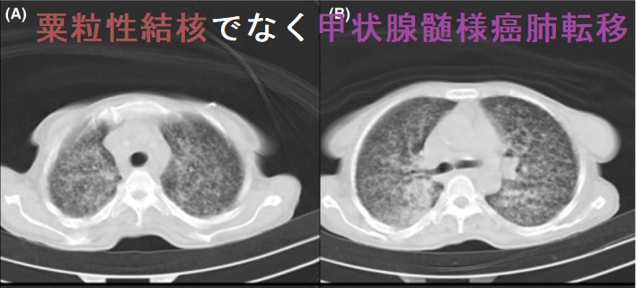 粟粒性結核でなく甲状腺髄様癌肺転移 CT画像 粟粒性結核でなく甲状腺髄様癌肺転移 CT画像