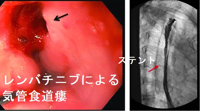 レンバチニブによる気管食道瘻 レンバチニブによる気管食道瘻