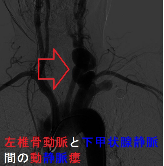 左椎骨動脈と下甲状腺静脈間の動静脈瘻 左椎骨動脈と下甲状腺静脈間の動静脈瘻