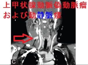 上甲状腺動脈偽動脈瘤および動静脈瘻 上甲状腺動脈偽動脈瘤および動静脈瘻