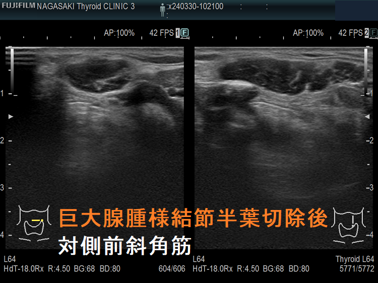 巨大腺腫様結節半葉切除後対側前斜角筋 巨大腺腫様結節半葉切除後対側前斜角筋