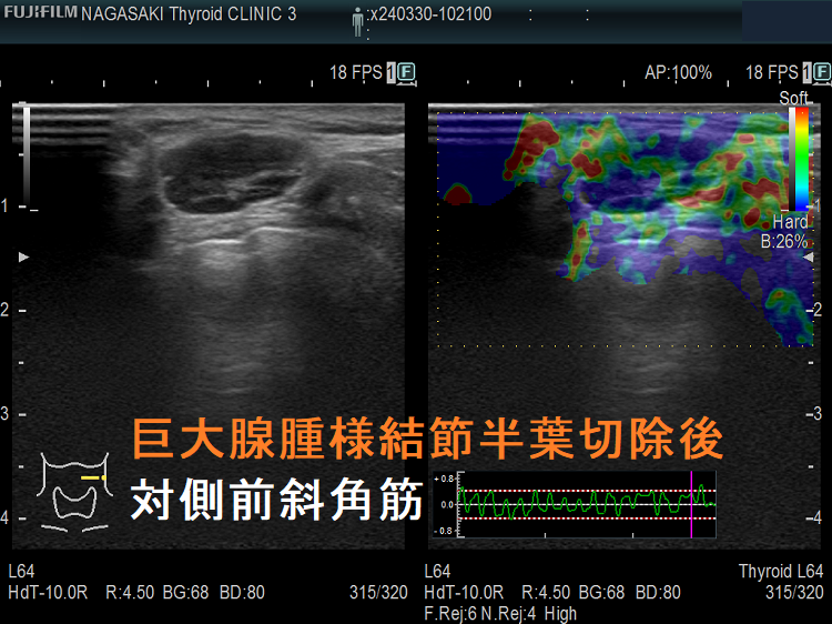 巨大腺腫様結節半葉切除後対側前斜角筋 エラストグラフィー 巨大腺腫様結節半葉切除後対側前斜角筋 エラストグラフィー