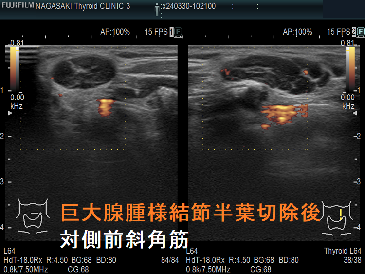 巨大腺腫様結節半葉切除後t対側前斜角筋 ドプラーモード 巨大腺腫様結節半葉切除後t対側前斜角筋 ドプラーモード