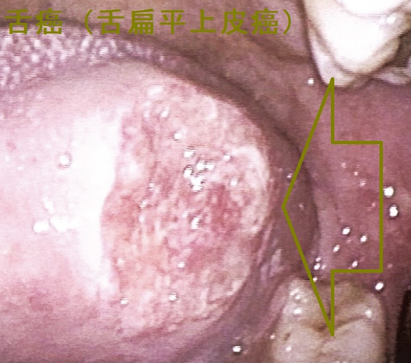 舌癌(舌扁平上皮癌)口腔内視鏡像 舌癌(舌扁平上皮癌)口腔内視鏡像