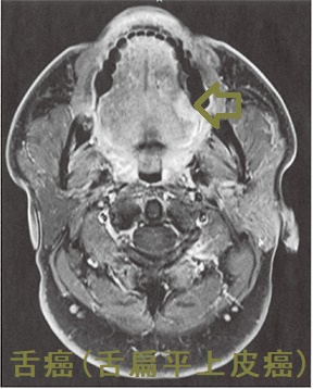 舌癌(舌扁平上皮癌)MRI 脂肪抑制造影T1強調水平断像 舌癌(舌扁平上皮癌)MRI 脂肪抑制造影T1強調水平断像