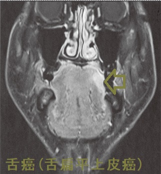 舌癌(舌扁平上皮癌)MRI 脂肪抑制造影T1強調冠状断像 舌癌(舌扁平上皮癌)MRI 脂肪抑制造影T1強調冠状断像