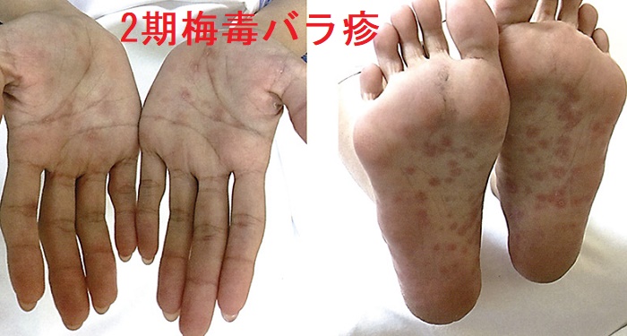 2期梅毒 バラ疹 2期梅毒 バラ疹
