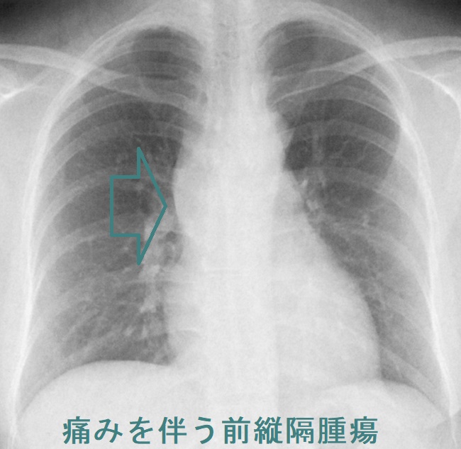 胸腺腫・胸腺過形成・胸腺癌・異所性胸腺・迷入胸腺・胸腺嚢胞と