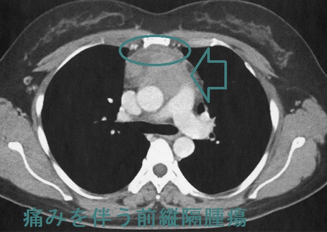 痛みを伴う前縦隔腫瘍 造影CT画像 痛みを伴う前縦隔腫瘍 造影CT画像