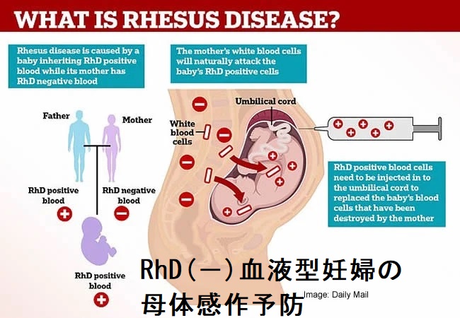 RhD(-)血液型妊婦の母体感作予防 RhD(-)血液型妊婦の母体感作予防
