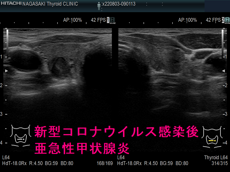 新型コロナウイルス感染後亜急性甲状腺炎 超音波(エコー)画像 新型コロナウイルス感染後亜急性甲状腺炎 超音波(エコー)画像