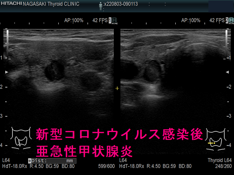 新型コロナウイルス感染後亜急性甲状腺炎(右葉) 新型コロナウイルス感染後亜急性甲状腺炎(右葉)