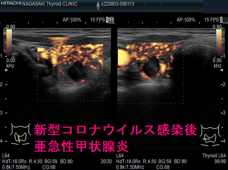 新型コロナウイルス感染後亜急性甲状腺炎(右葉)ドプラーモード 新型コロナウイルス感染後亜急性甲状腺炎(右葉)ドプラーモード