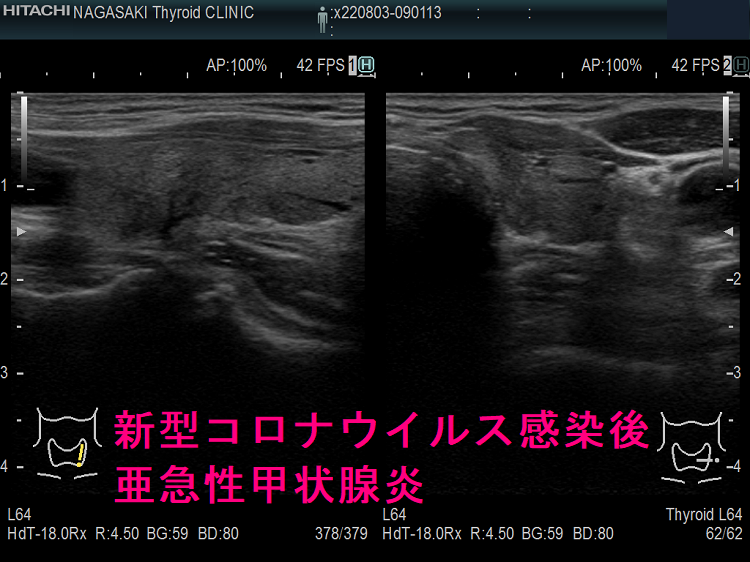 新型コロナウイルス感染後亜急性甲状腺炎(左葉) 新型コロナウイルス感染後亜急性甲状腺炎(左葉)