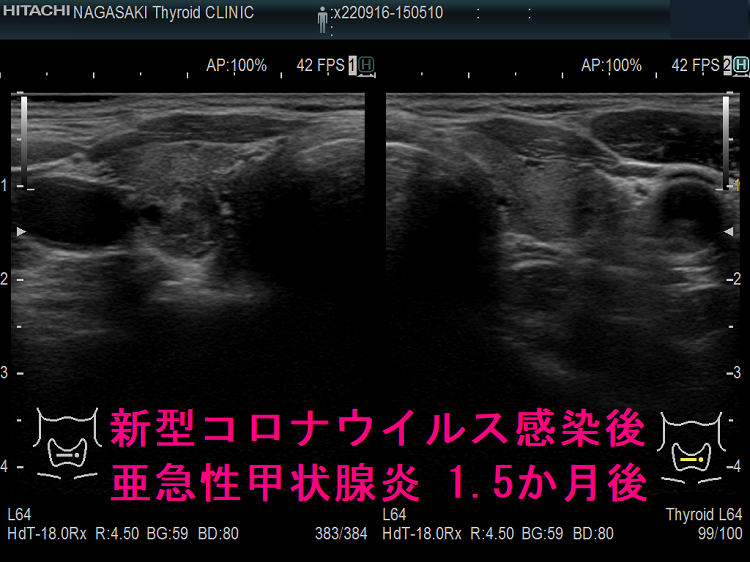 新型コロナウイルス感染後亜急性甲状腺炎 1.5か月後 新型コロナウイルス感染後亜急性甲状腺炎 1.5か月後