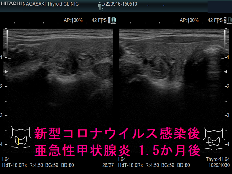 新型コロナウイルス感染後亜急性甲状腺炎 1.5か月後 (右葉) 新型コロナウイルス感染後亜急性甲状腺炎 1.5か月後 (右葉)
