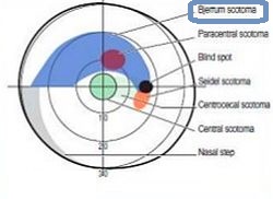 ビルエム暗点 ビルエム暗点