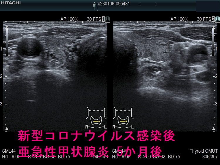 新型コロナウイルス感染後亜急性甲状腺炎 5か月後 新型コロナウイルス感染後亜急性甲状腺炎 5か月後