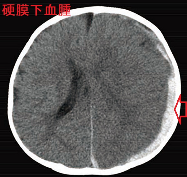 硬膜下血腫 CT画像 硬膜下血腫 CT画像