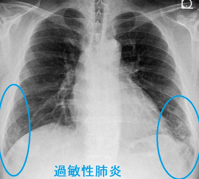 過敏性肺炎 胸部エックス線写真 過敏性肺炎 胸部エックス線写真