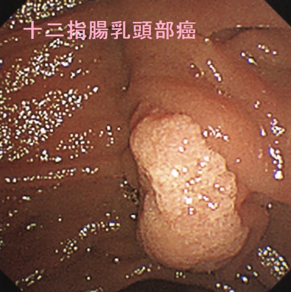 十二指腸乳頭部癌 十二指腸乳頭部癌