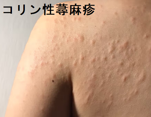 コリン性蕁麻疹 コリン性蕁麻疹