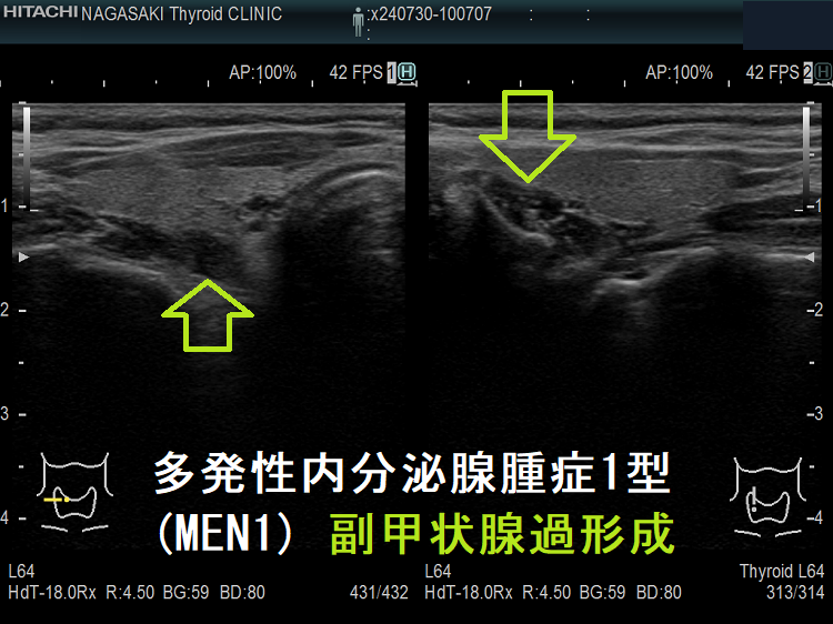 甲状腺乳頭癌と多発性内分泌腺腫症1型(MEN1)[橋本病 バセドウ病