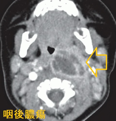 咽後膿瘍 造影CT画像 矢状面 咽後膿瘍 造影CT画像 矢状面