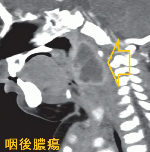 咽後膿瘍 造影CT画像 矢状面 咽後膿瘍 造影CT画像 矢状面