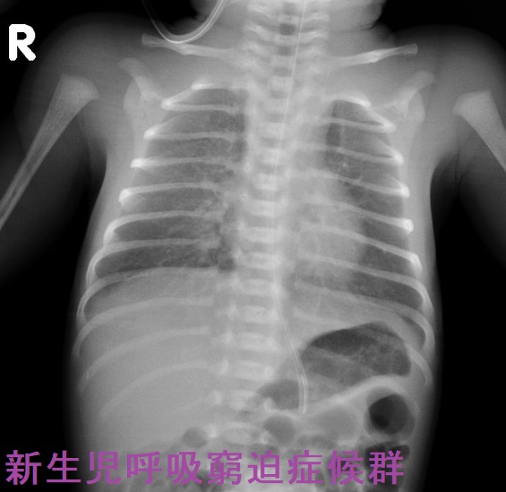 新生児呼吸窮迫症候群 新生児呼吸窮迫症候群