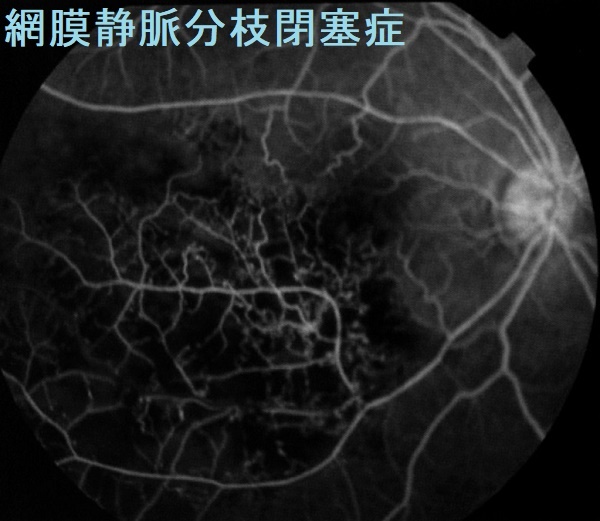 網膜静脈分枝閉塞症 蛍光眼底検査 網膜静脈分枝閉塞症 蛍光眼底検査