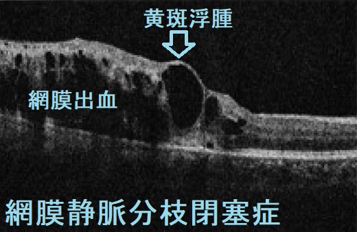網膜静脈分枝閉塞症 光干渉断層計(OCT) 網膜静脈分枝閉塞症 光干渉断層計(OCT)