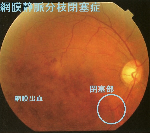 網膜静脈分枝閉塞症 眼底写真 網膜静脈分枝閉塞症 眼底写真