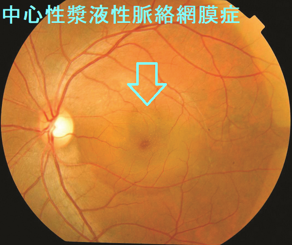中心性漿液性脈絡網膜症 中心性漿液性脈絡網膜症