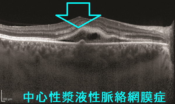 中心性漿液性脈絡網膜症 光干渉断層計(OCT) 中心性漿液性脈絡網膜症 光干渉断層計(OCT)