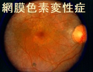 網膜色素変性症 網膜色素変性症