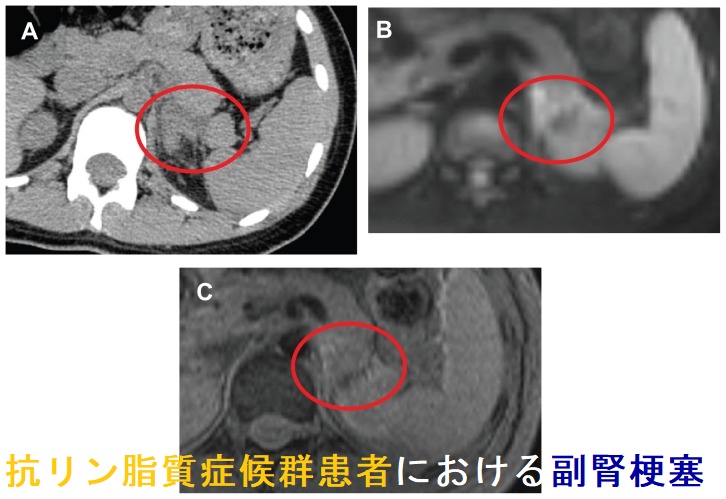 抗リン脂質症候群患者における副腎梗塞 抗リン脂質症候群患者における副腎梗塞