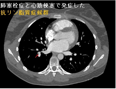 肺塞栓症と心筋梗塞で発症した抗リン脂質症候群 肺塞栓症と心筋梗塞で発症した抗リン脂質症候群