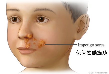 伝染性膿痂疹 伝染性膿痂疹