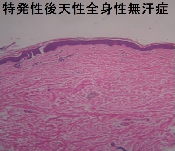 特発性後天性全身性無汗症 特発性後天性全身性無汗症