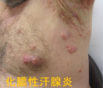 化膿性汗腺炎 化膿性汗腺炎