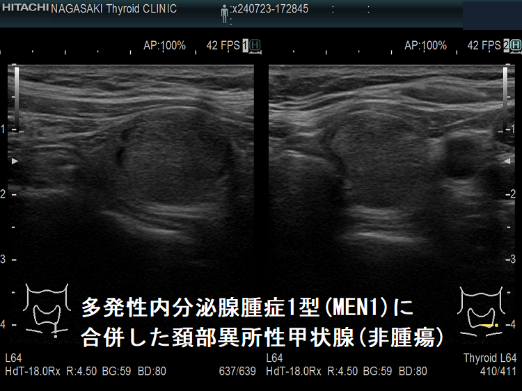 多発性内分泌腺腫症1型(MEN1)に合併した頚部異所性甲状腺(非腫瘍) 多発性内分泌腺腫症1型(MEN1)に合併した頚部異所性甲状腺(非腫瘍)