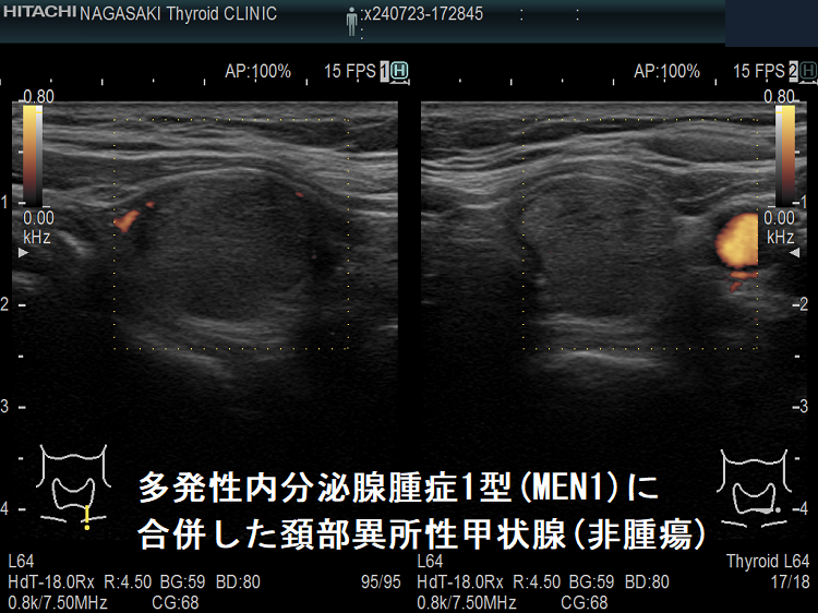 多発性内分泌腺腫症1型(MEN1)に合併した頚部異所性甲状腺(非腫瘍)ドプラーモード 多発性内分泌腺腫症1型(MEN1)に合併した頚部異所性甲状腺(非腫瘍)ドプラーモード