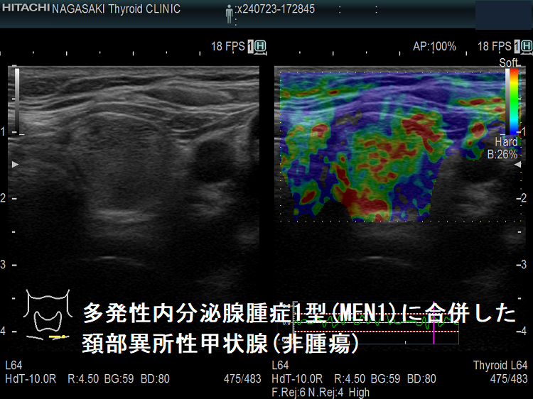 多発性内分泌腺腫症1型(MEN1)に合併した頚部異所性甲状腺(非腫瘍)エラストグラフィー 多発性内分泌腺腫症1型(MEN1)に合併した頚部異所性甲状腺(非腫瘍)エラストグラフィー
