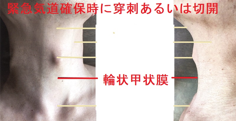 緊急気道確保時に穿刺あるいは切開 緊急気道確保時に穿刺あるいは切開