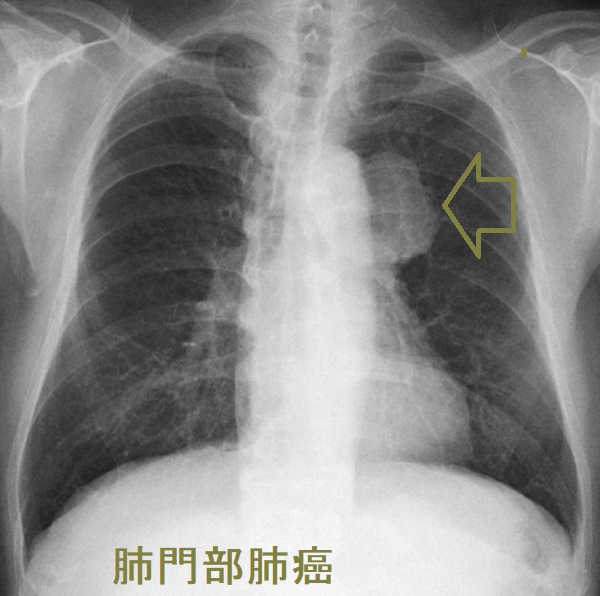 肺門部肺癌 胸部X-p写真 肺門部肺癌 胸部X-p写真