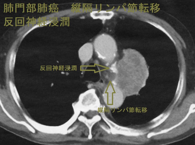 肺門部肺癌 縦隔リンパ節転移 反回神経浸潤 肺門部肺癌 縦隔リンパ節転移 反回神経浸潤