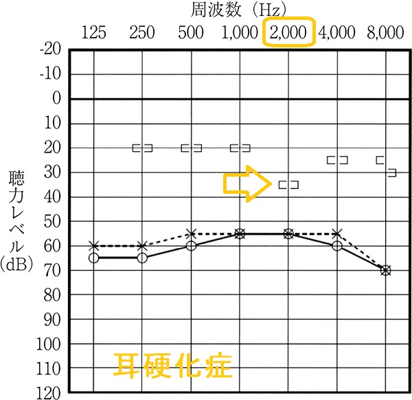 耳硬化症 オージオグラム 耳硬化症 オージオグラム