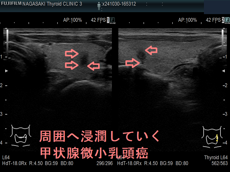 周囲へ浸潤していく石灰化の無い甲状腺微小乳頭癌 周囲へ浸潤していく石灰化の無い甲状腺微小乳頭癌